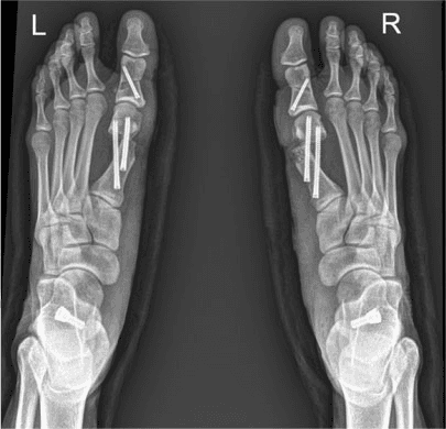 X-ray of Minimally Invasive Foot Surgery