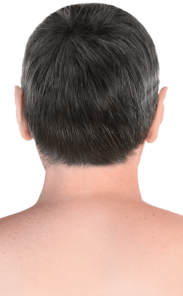 Patient follow-up before and after hair transplantation