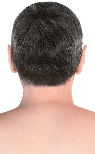 Patient follow-up before and after hair transplantation