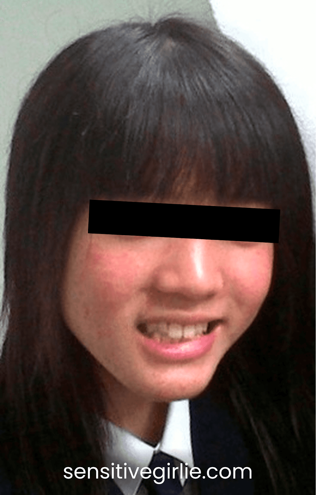 หน้าแพ้สารสเตียรอยด์