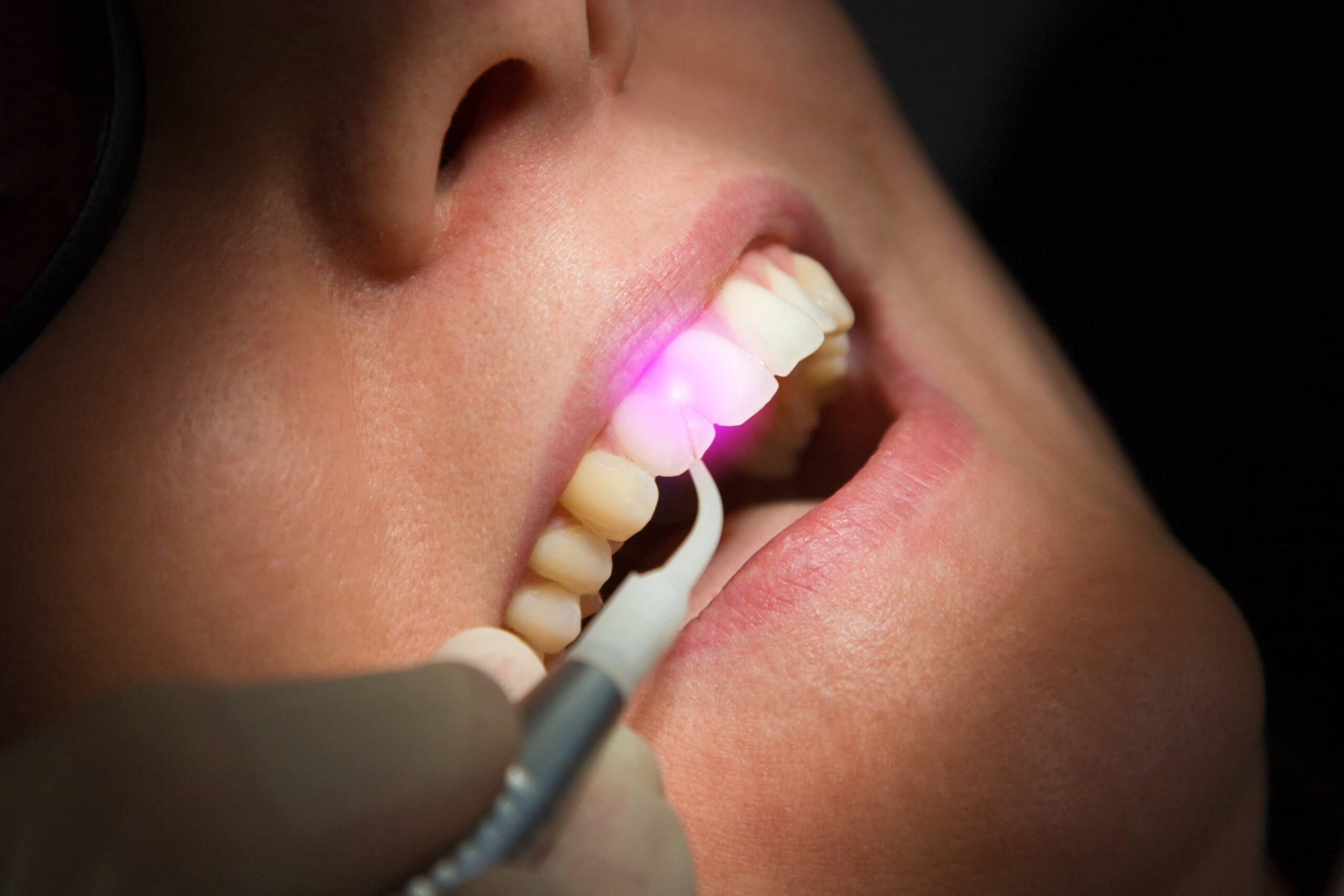 Laser Treatment at ScarboroSmiles Dental Clinic in Scarborough, ON | Best dentist in Scarborough.