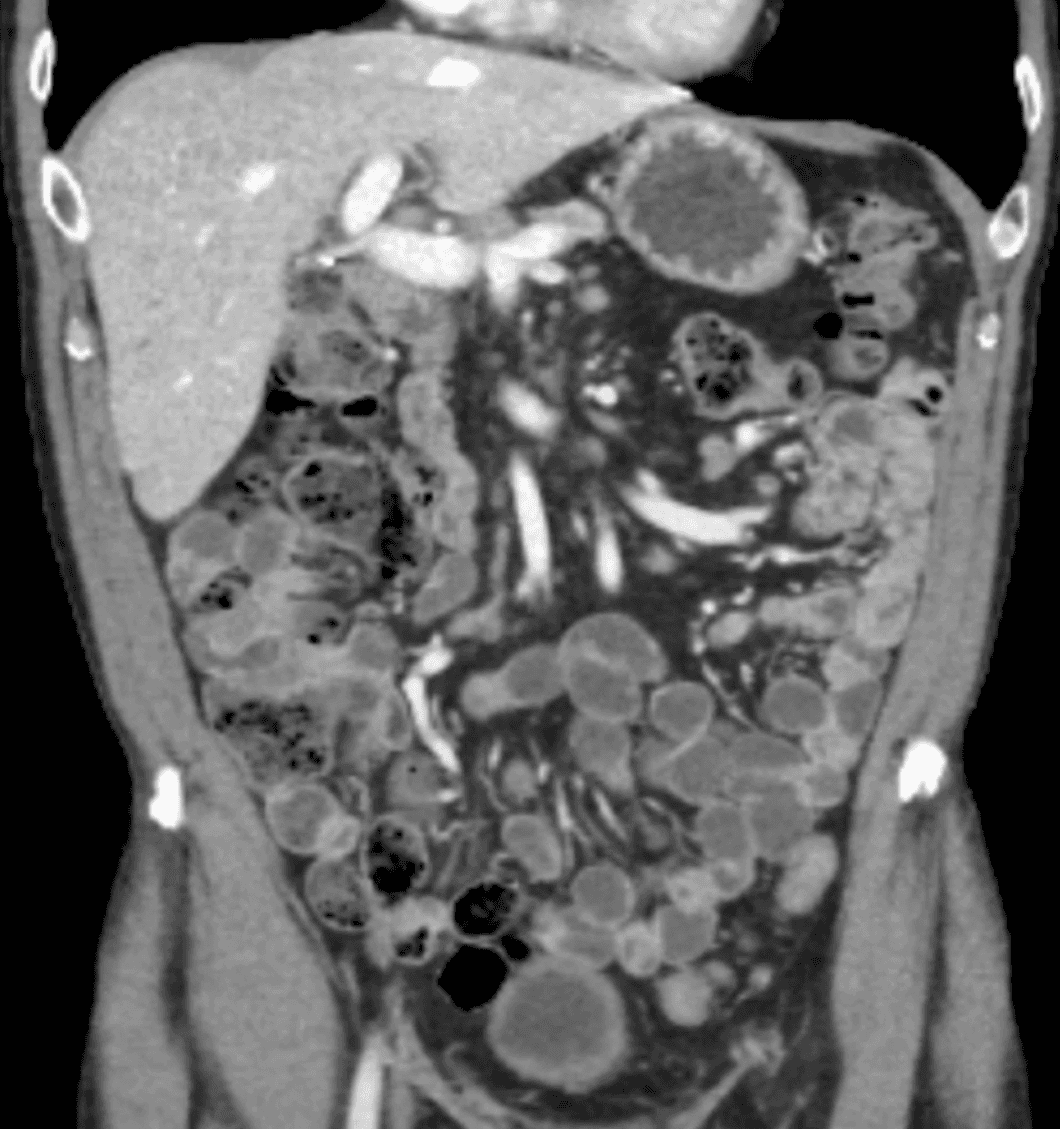 Conventional oral contrast image state
