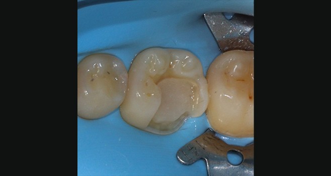 베이스 레진필링후 프랩 사진