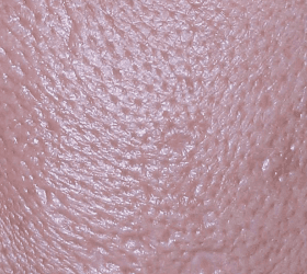 큐어젯 쥬베룩 시술 을 하기 전 파인 흉터 |  홍대피부과 뷰티스톤의원