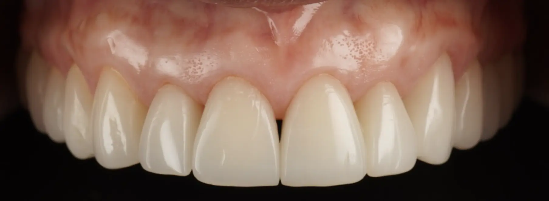 Temporary crowns on frontal teeth, changing old composite restorations (before and after)