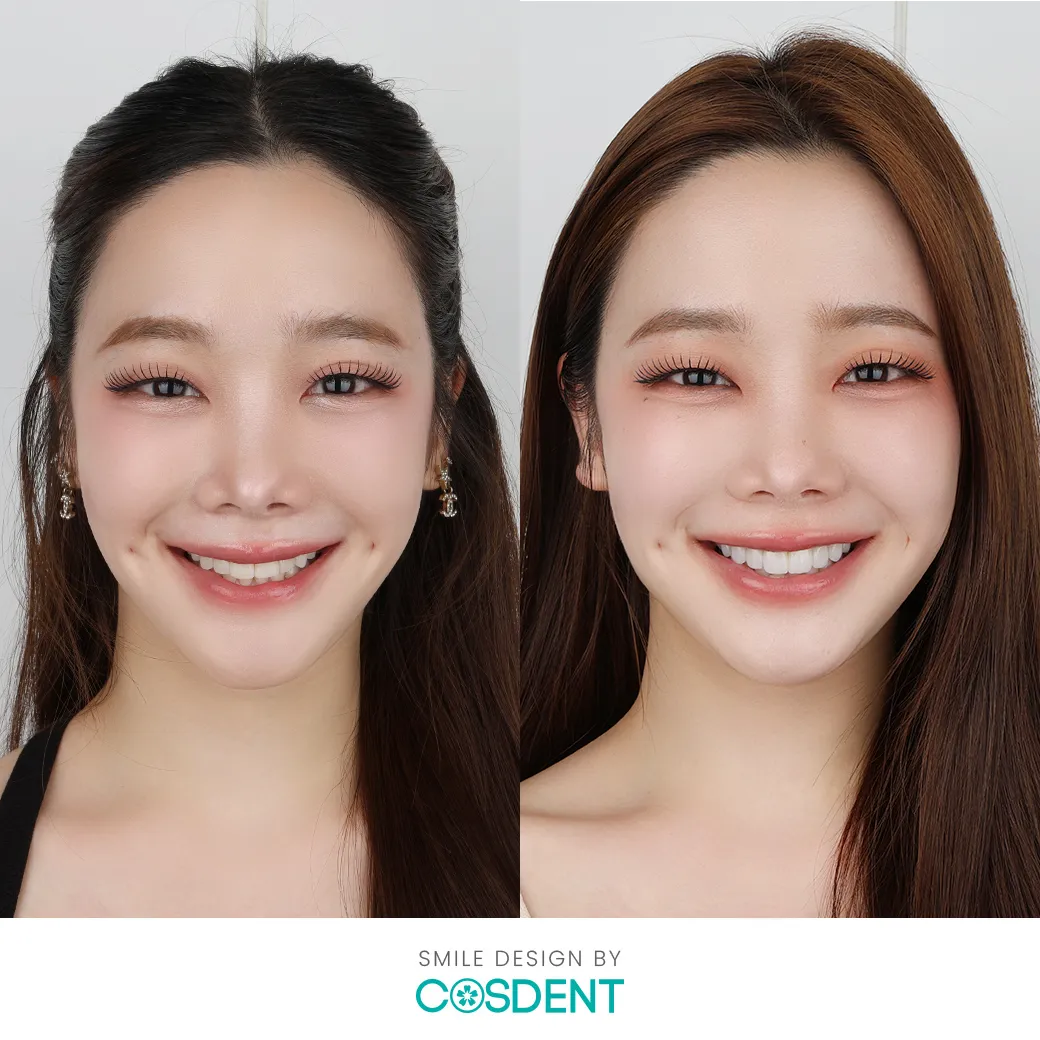 รีวิวออกแบบรอยยิ้มวีเนียร์ cosdent smile design