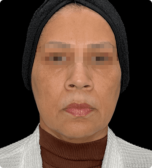 MICRONEEDLING - BEFORE