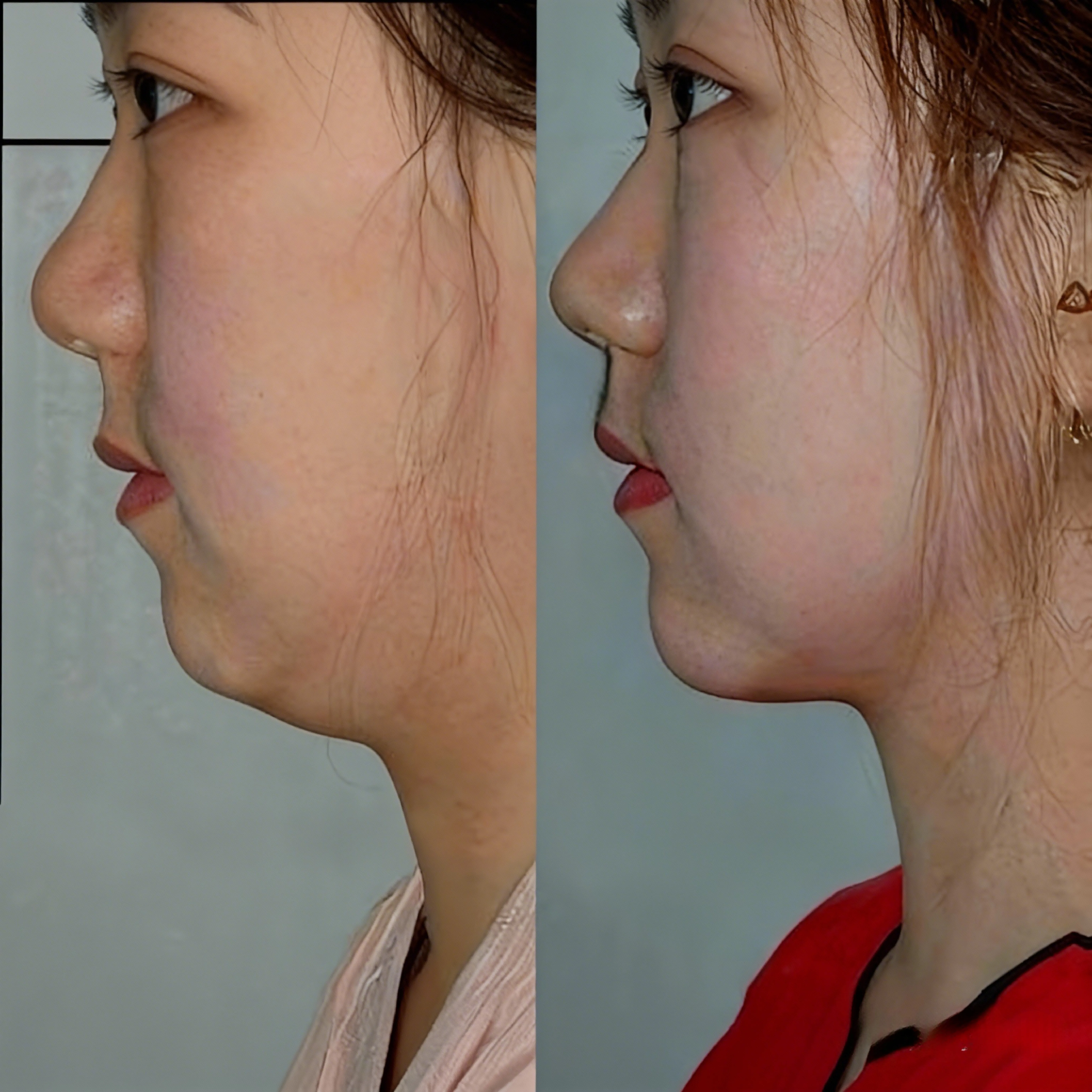 B2B DCA fat dissolving injections for double chin treatment