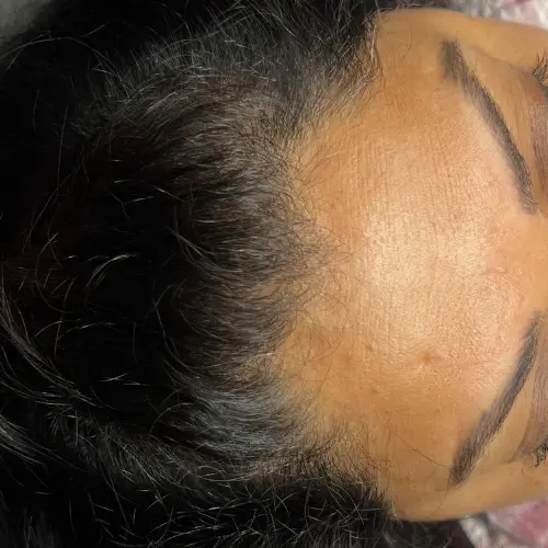 After microneedling hair loss treatment at The Vancouver Aesthetician — bald patches filled in and hairline visibly restored with natural regrowth