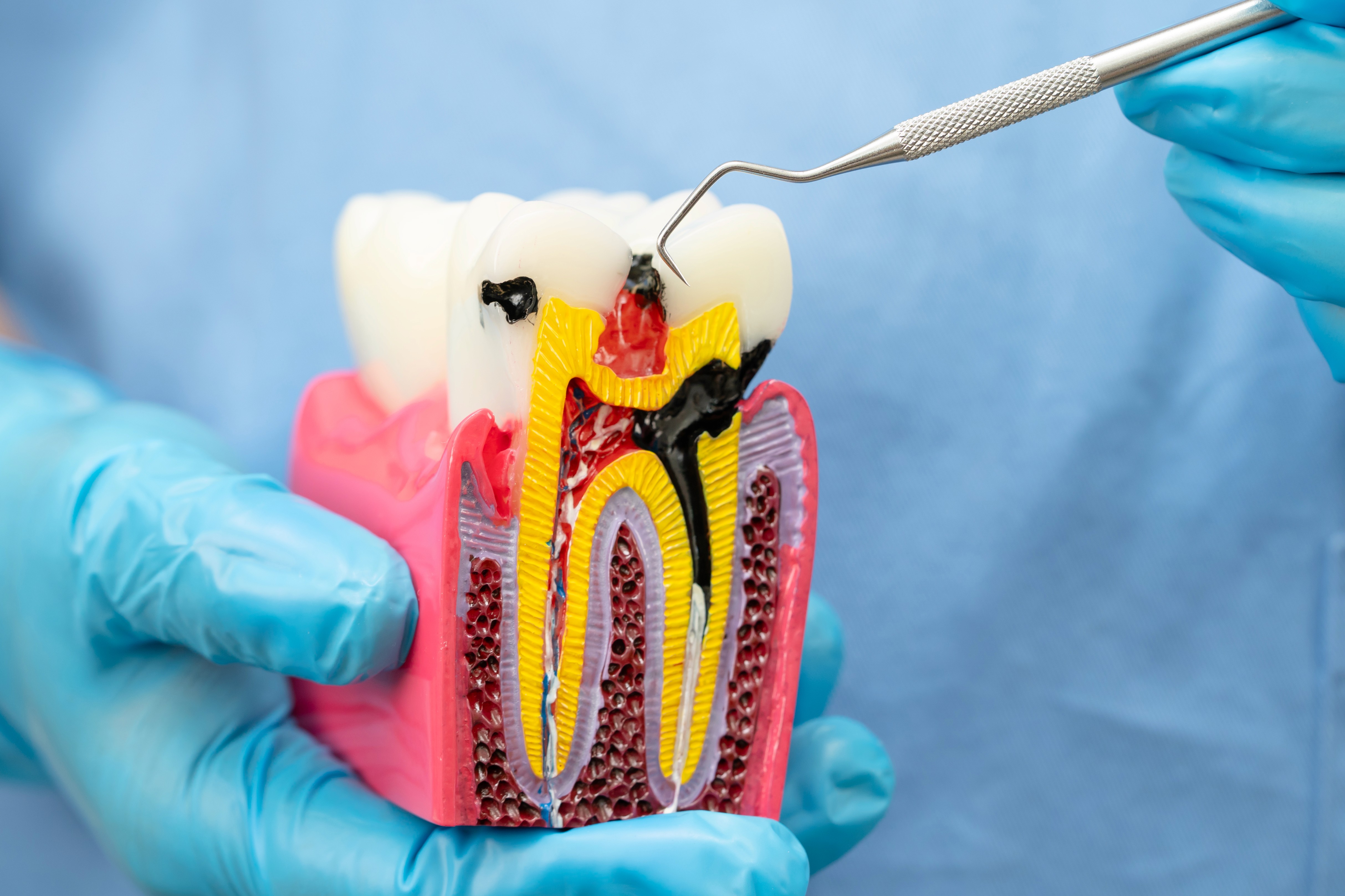 Enlarged example of a root canal situation