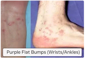 Purple, flat bumps (wrists/ankles)