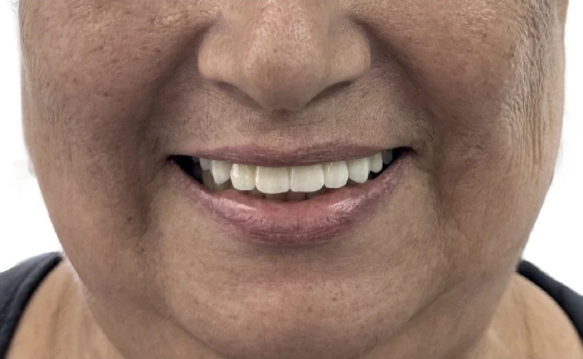 Paciente de Distrito Dental despues de hacerse un implante dental