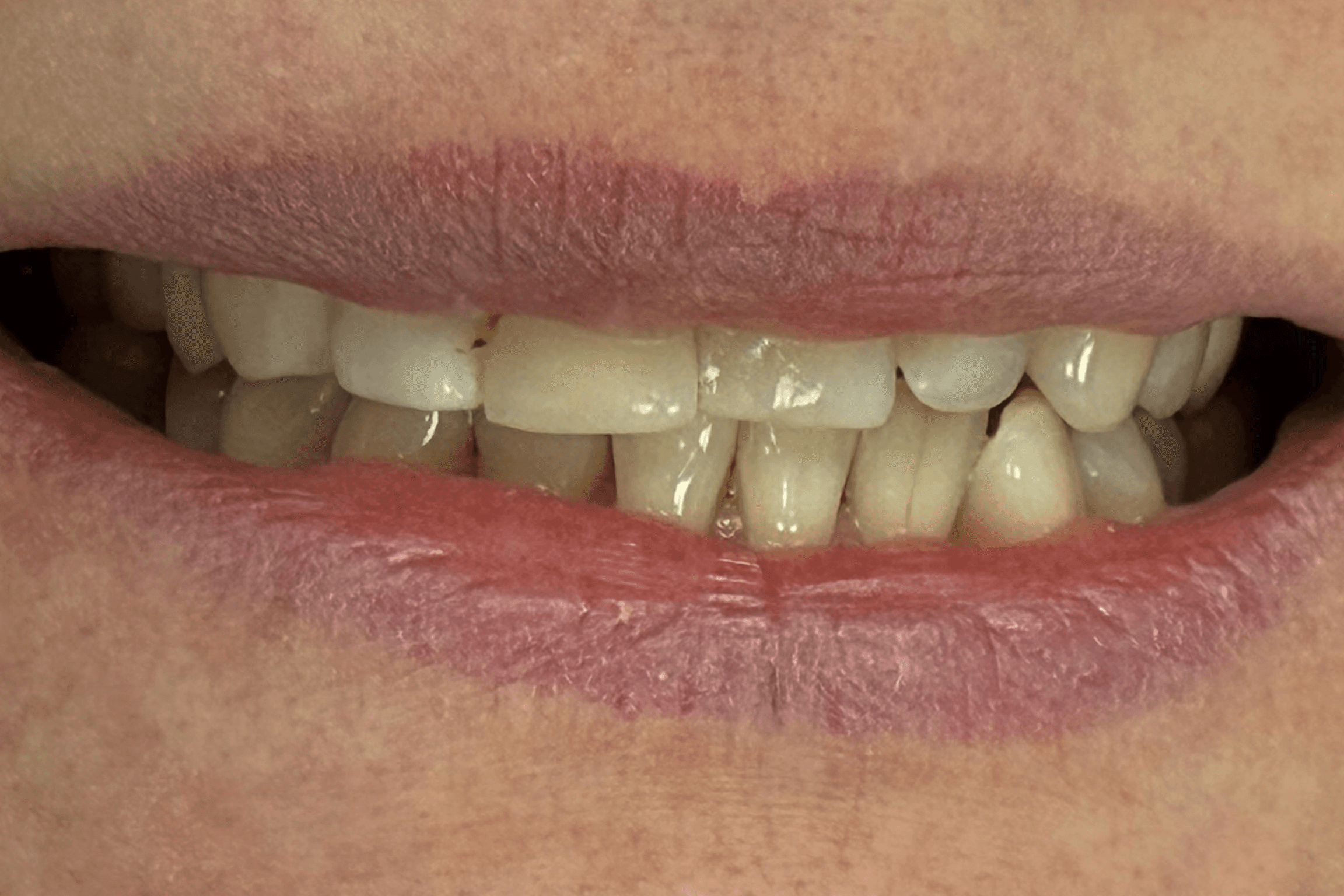 Crowns, Smile redesign, Full mouth rehabilitation - before treatment