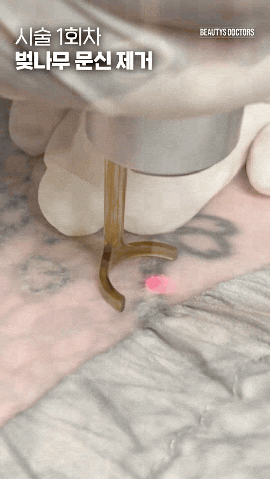 대형문신제거 횟수 안내 - 홍대 뷰티스톤의원