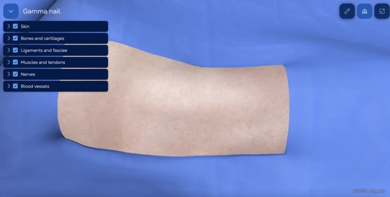 Gamma Nail for Intertrochanteric Femoral Fracture
