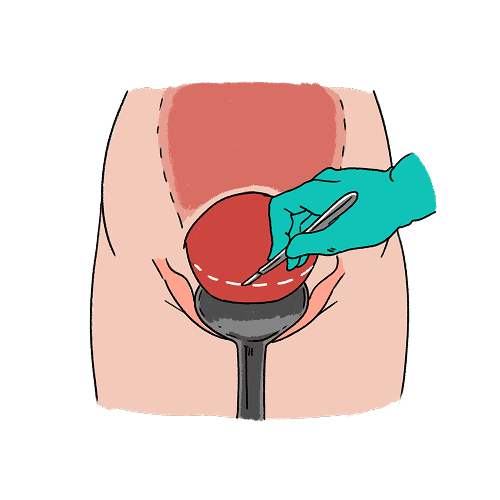 An illustration showing where a doctor will cut into the abdomen and womb to perform a caesarean. It is across the bikini line which is at the lower point of the womb.