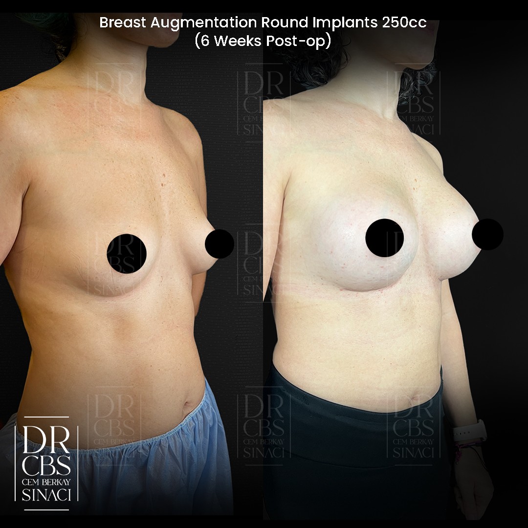 breast implant 6 weeks result right oblique view