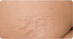 Body texture and stretch marks