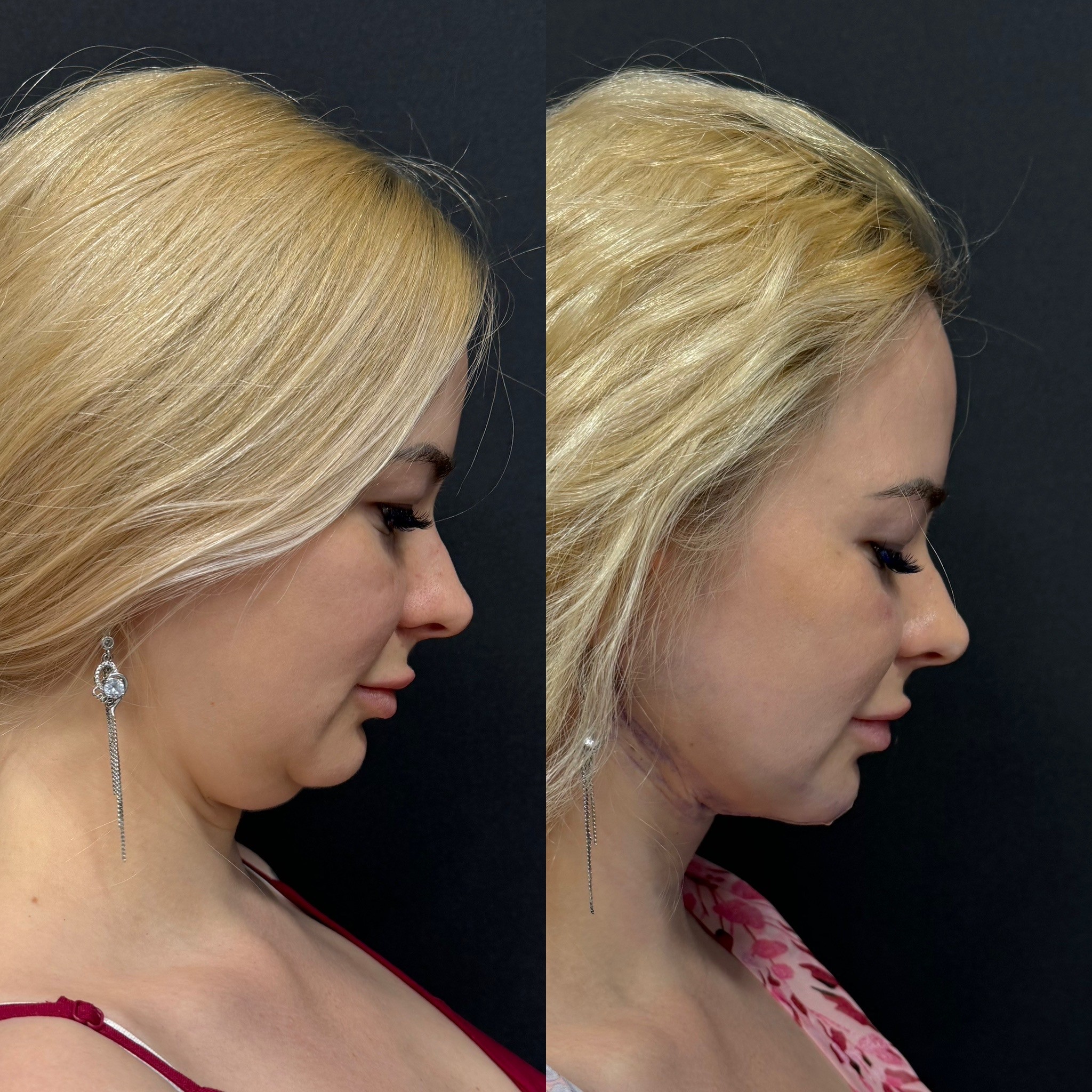 double chin liposuction before after 1 day post-surgery side view