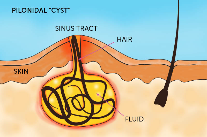 À quoi ressemble un kyste pilonidal sous la peau, voir cette illustration