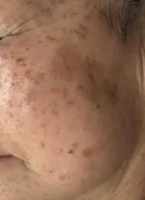 Facial skin showing melasma and hyperpigmentation sun spots.