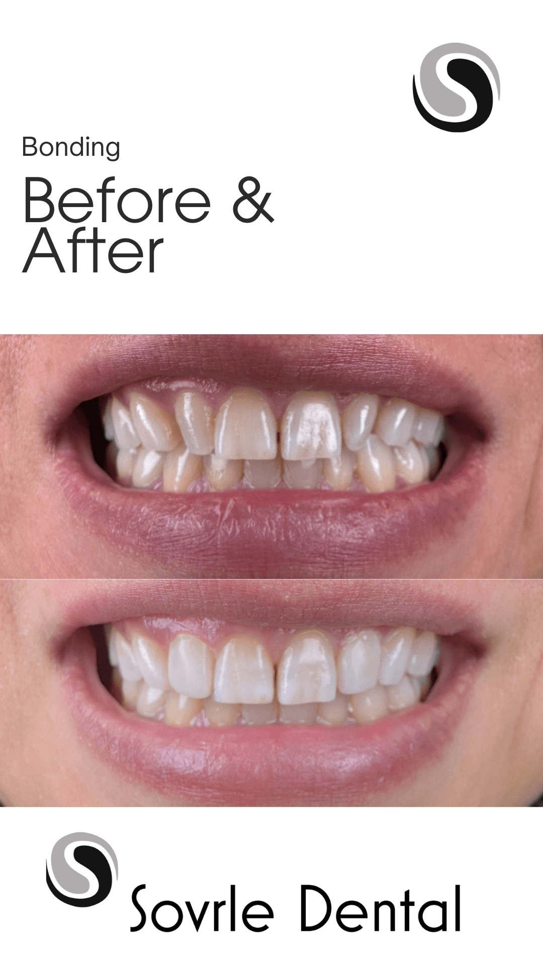 Before and After Dental Bonding at Sovrle Dental Clinic | Best dentist in North York