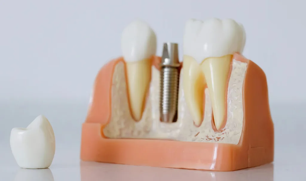 smyrna dental implant