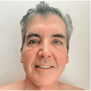 turkey neck patient from USA