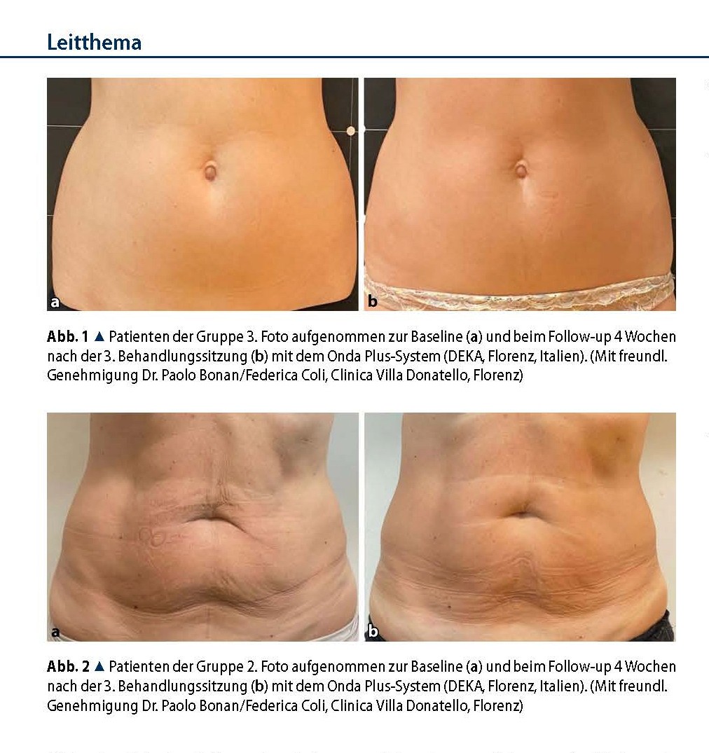 average waist circumference reduction of 3.80 ± 1.21 cm