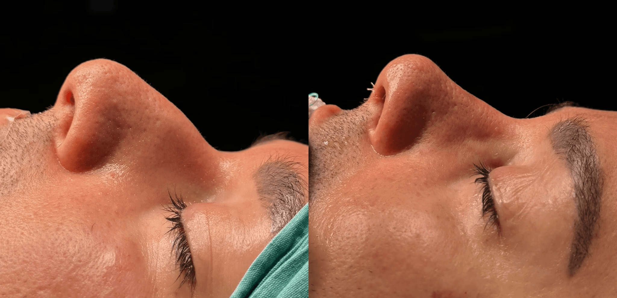 rhinoplasty patient immediate before after