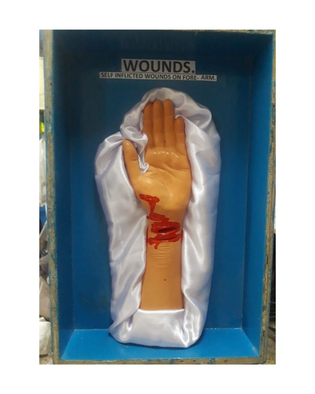 Self-Inflicted Wounds (Forearm)