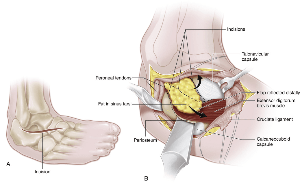 Illustration for Triple Arthrodesis Treatment