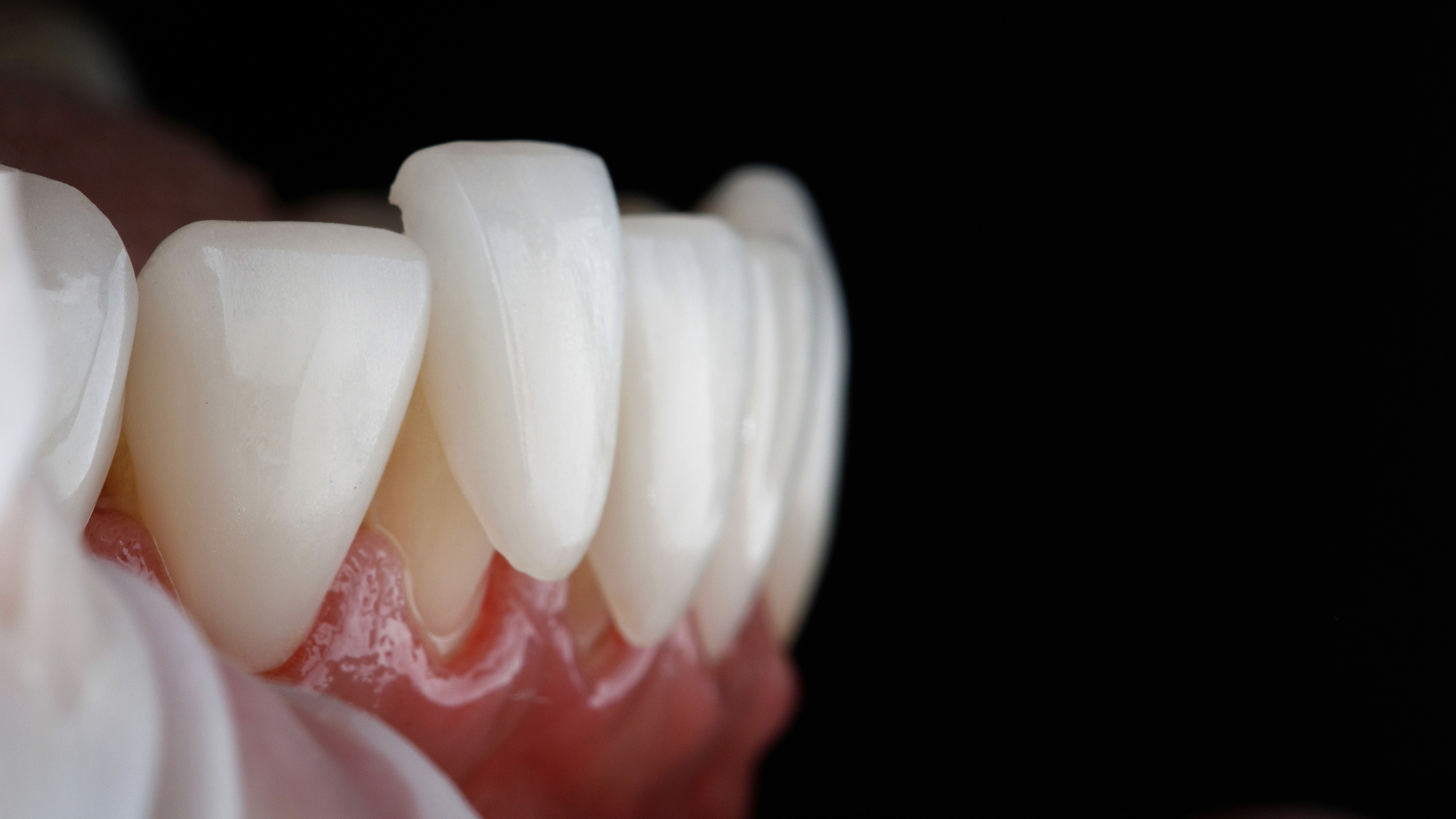 closeup image of dental veneer to show how porcelain veneers are applied to the tooth at the Invisalign Center in Dubai