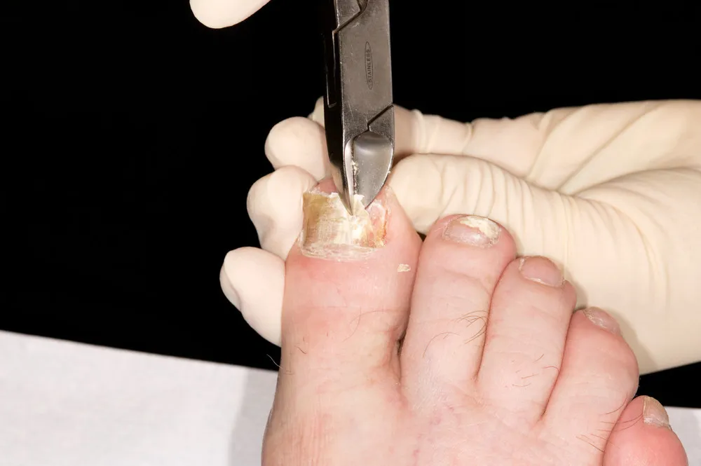 발톱무좀 치료 과정에서 손상된 발톱을 정리하는 의료 시술 장면