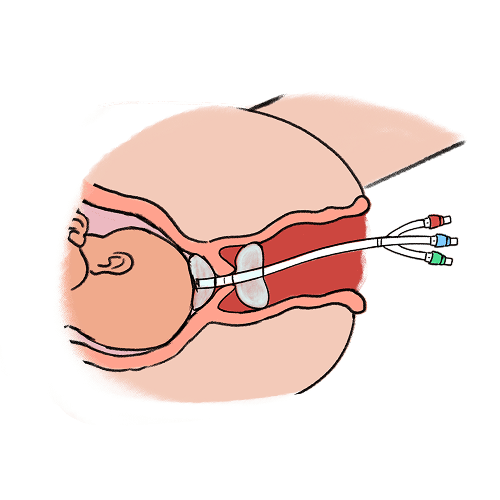 An illustration showing a cross-section of a baby inside the womb, a cervix, a vagina, and a balloon catheter placed through the cervix.  There are two balloons that are inflated one inside the womb against the amniontic membrane and one inside the vagina at the external part of the cervix.  The catheter extends along and out of the vagina.