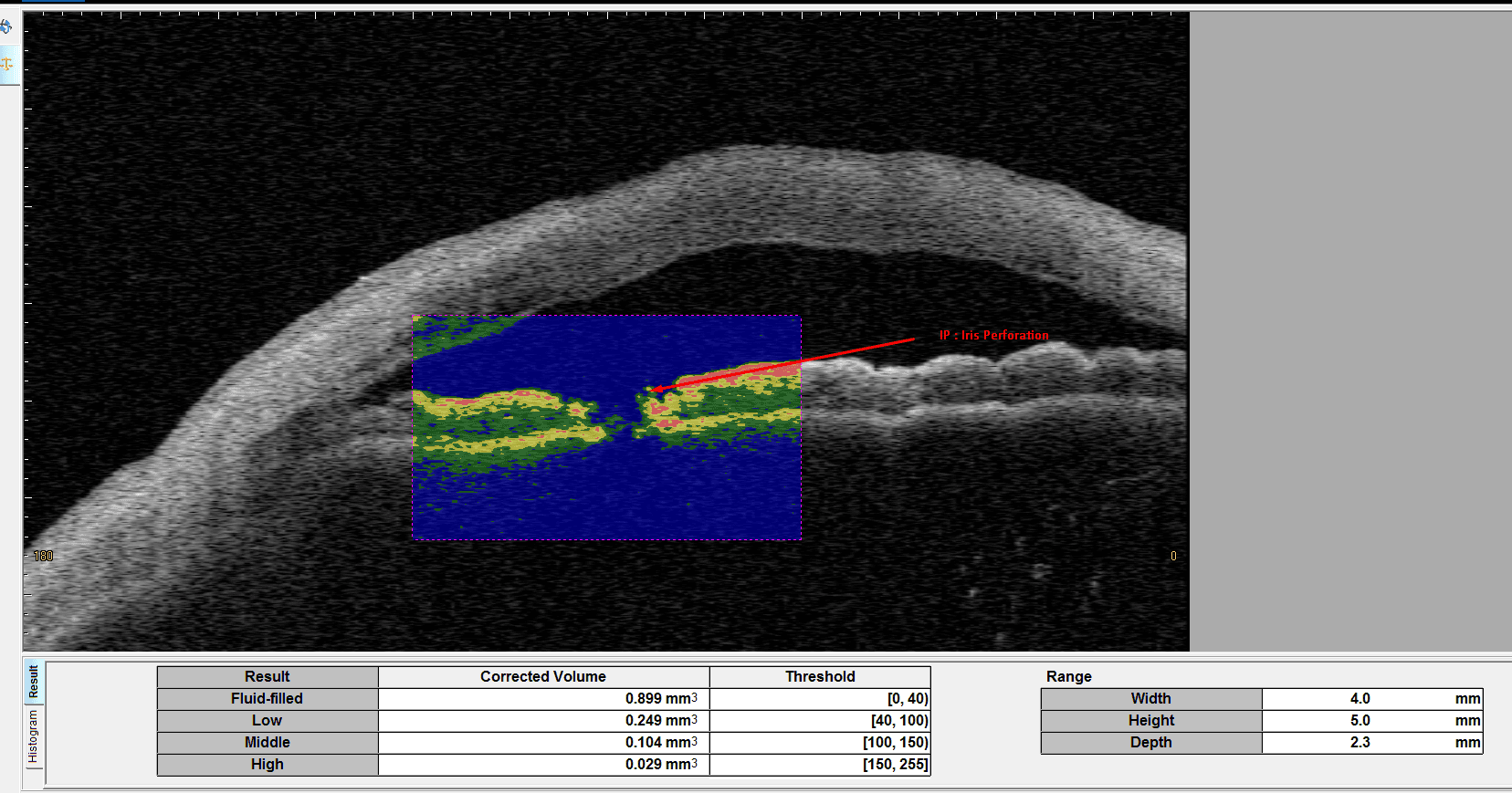 Bleb Casia 2 ( Pre/post-surgical monitoring in angle-closure suspects ) - VisReed