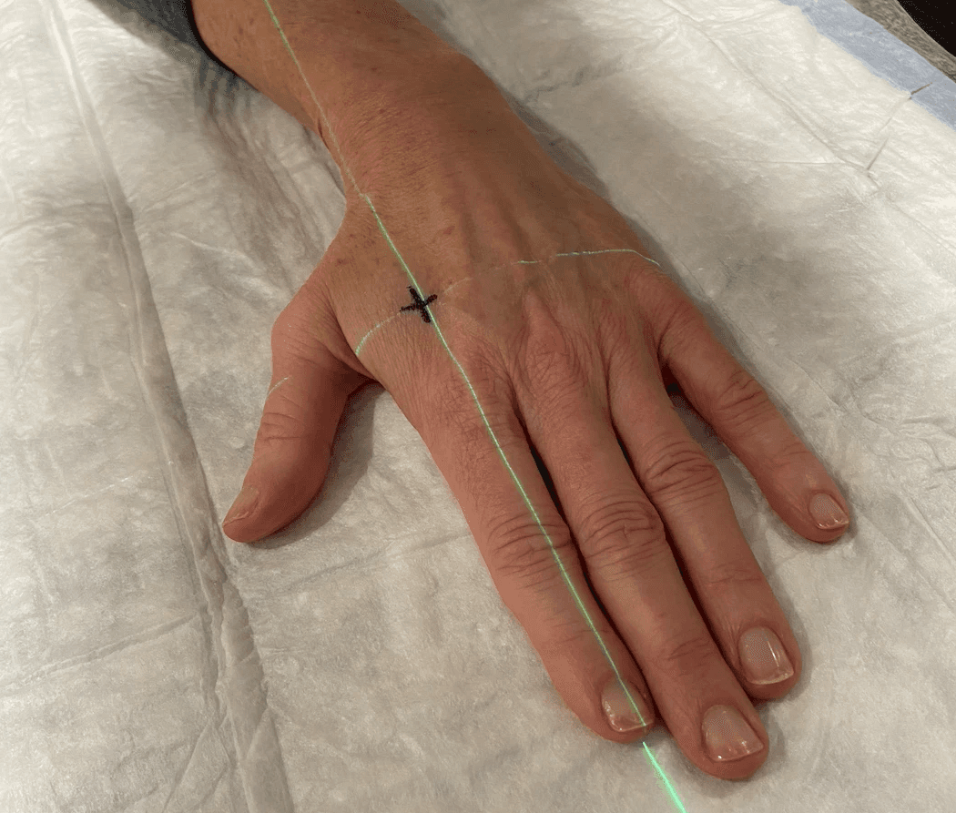 Tattoo Removal for ribcage and chest