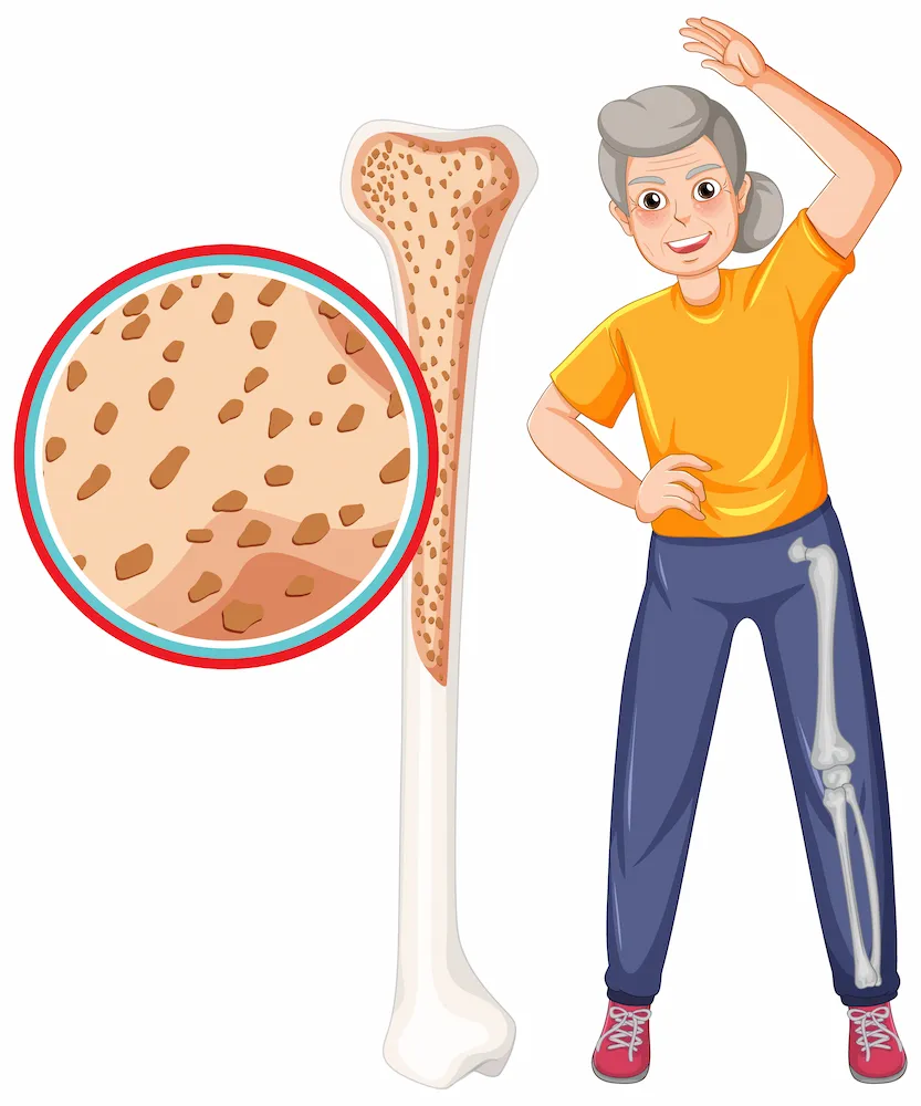 Osteoporosis is reduced bone density after 60 commonly