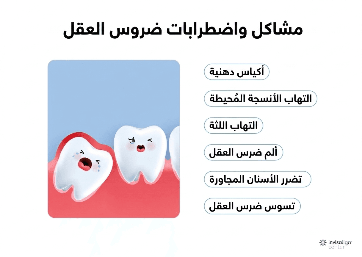 رسم توضيحي لضرس العقل من إعداد مركز انفزلاين، يظهر شكل ضرس العقل وأثره على الأسنان المجاورة