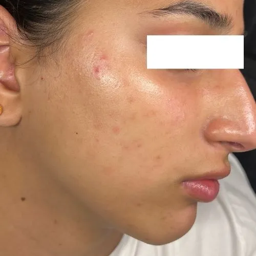 After exosome PDRN therapy at The Vancouver Aesthetician — acne cleared, inflammation resolved, and skin visibly repaired and restored