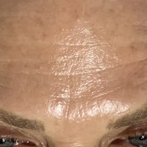 After HydraFacial MD at The Vancouver Aesthetician — skin visibly smoother, deeply hydrated, and glowing