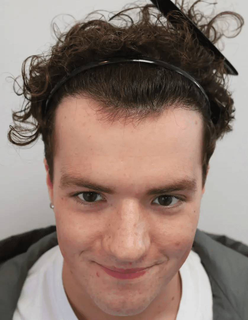 After hair transplant – Rory's FUE Hair Transplant