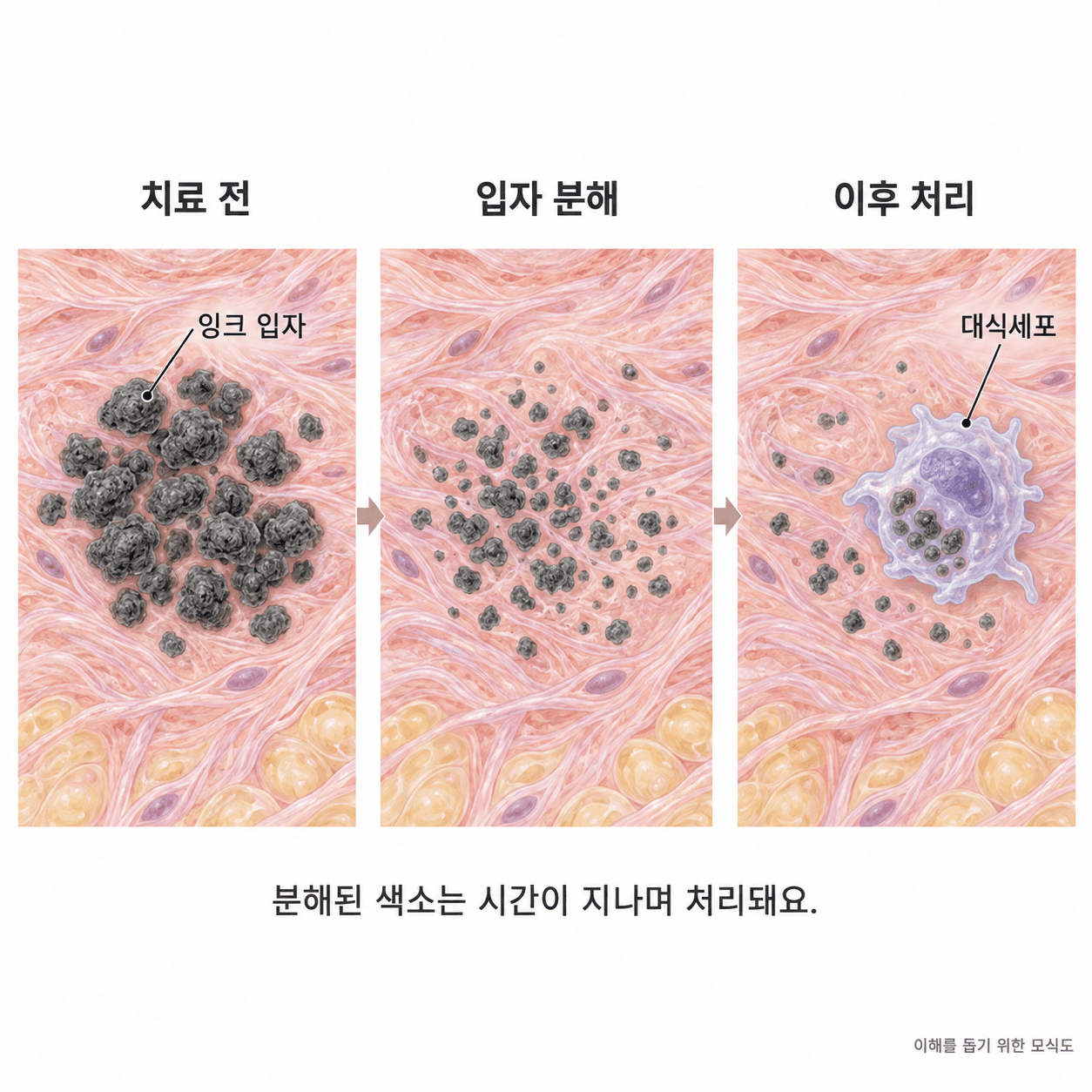 진피 속 잉크 입자의 분해와 대식세포에 의한 처리를 시간 순서로 보여주는 모식도