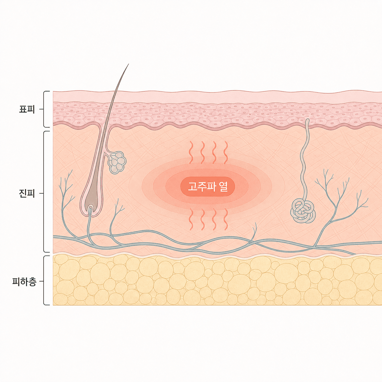 써마지의 열이 주로 진피에 작용하는 모습을 단순화한 그림이에요.