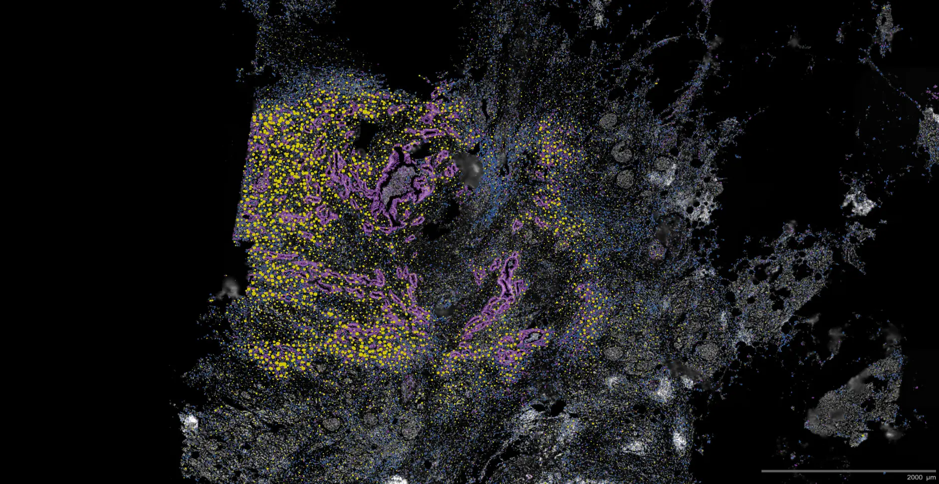 GBM-ES-SCLC- mPDAC-cancer