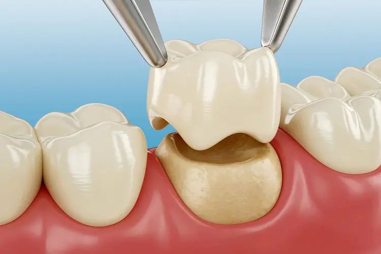 dental crowns in Plainview