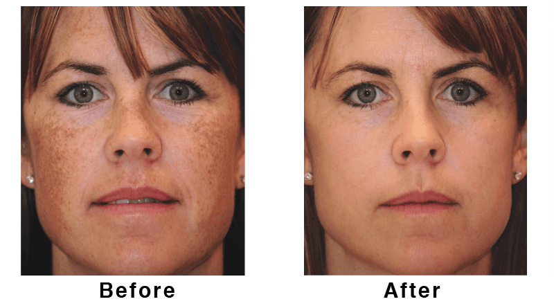 Before and after of surgery image