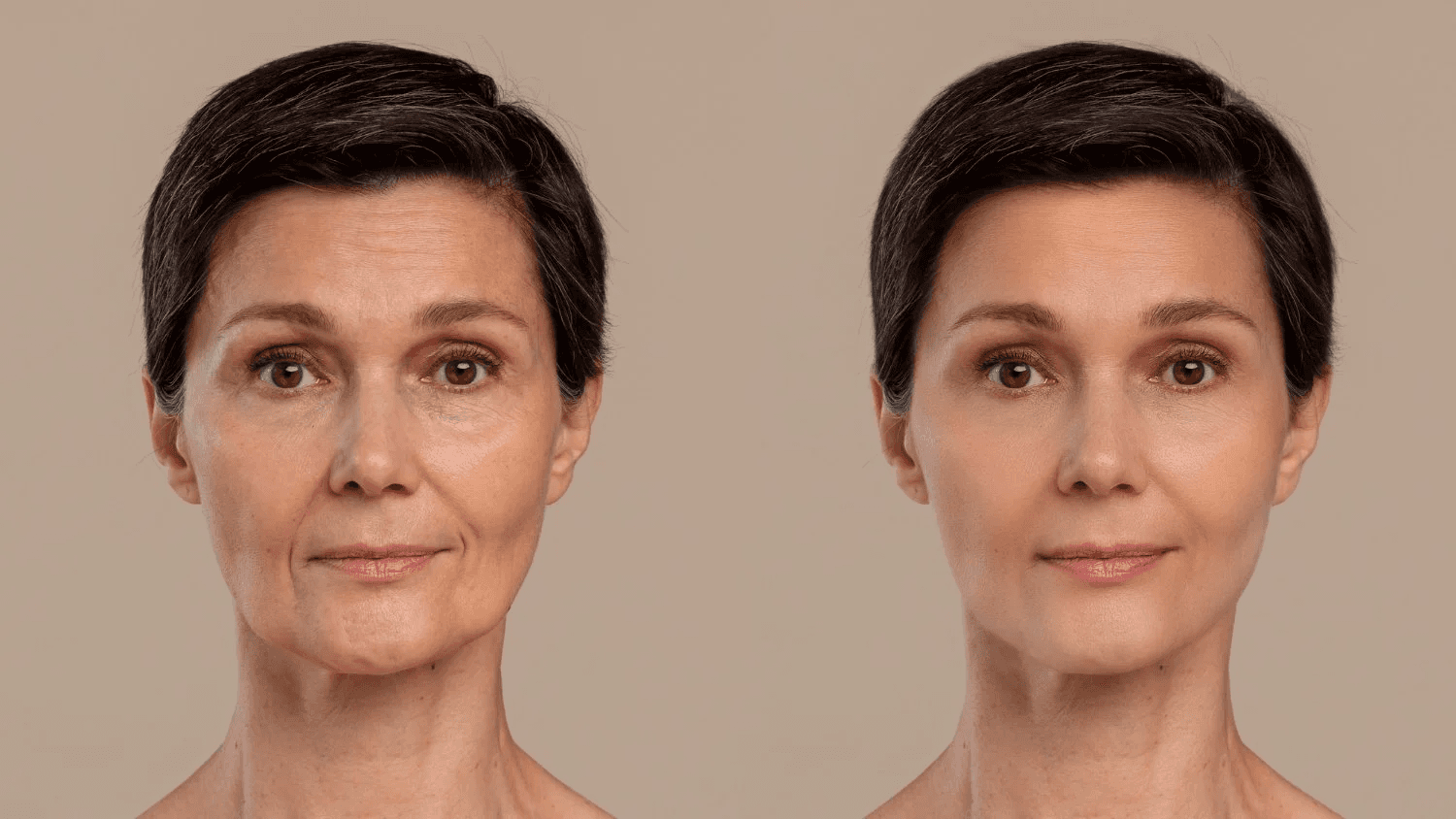 What is Ozempic Face and What Causes It