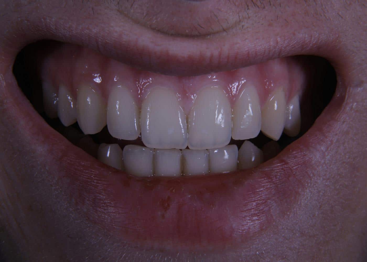 What stains teeth? Close up image of stained teeth