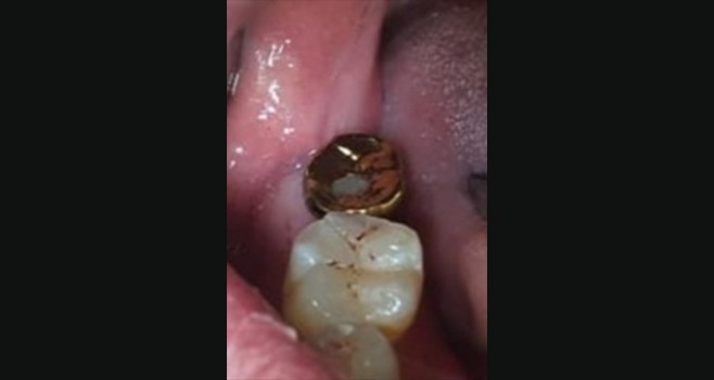 구강내 셋팅후 골드크라운처럼 보임